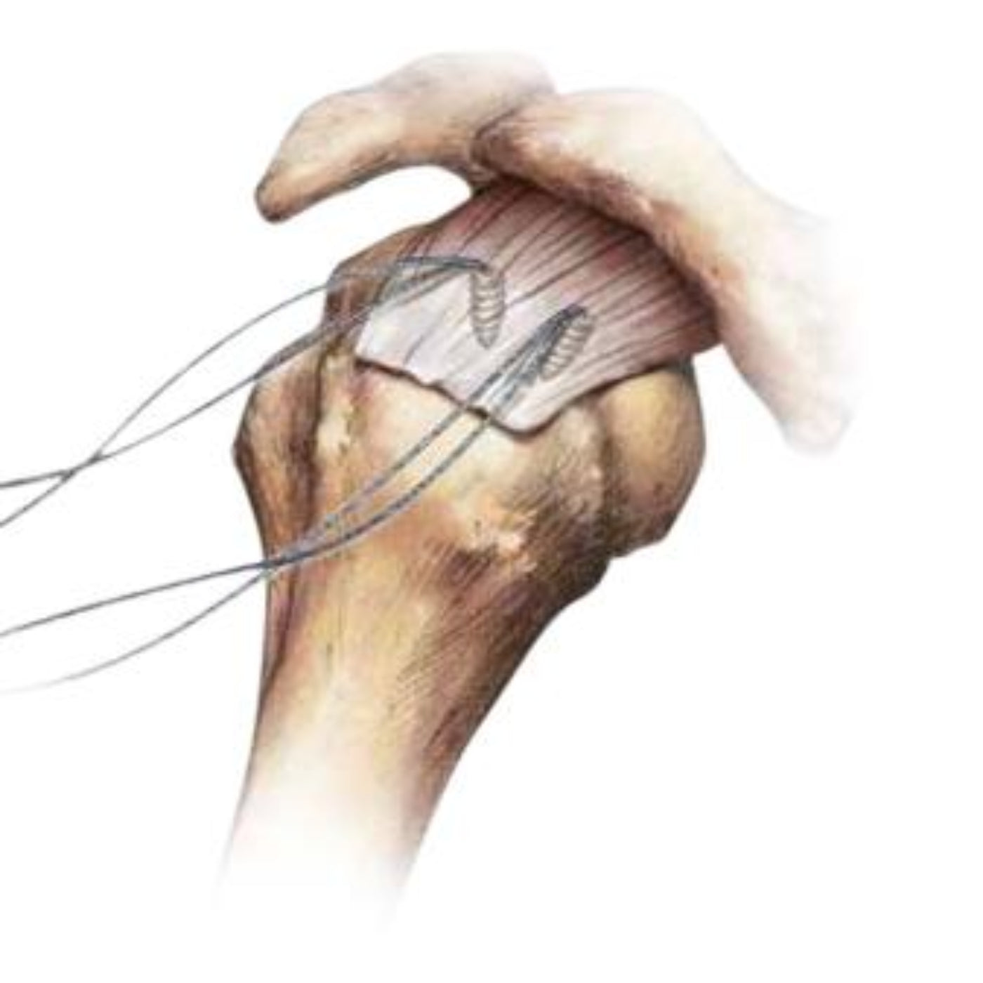 Zimmer Biomet BiPass Suture Pusher, VA Only, - BiPass Plastic Suture Pusher, VA Only - 902093